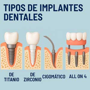 Tipos de implantes en clinicas dentales en Lleida